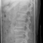 Fracture en diabolo type A2 de L5 Radio rachis lombaire profil Fracture en diabolo type A2 de L5 Radio rachis lombaire profil