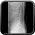 Fracture en diabolo type A2 de L5 Radio rachis lombaire profil