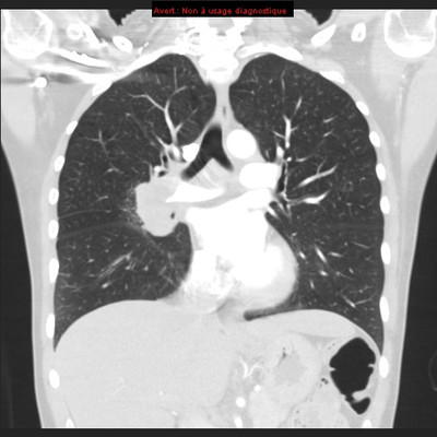 Adénocarcinome pulmonaire avec contingent à cellules claires TDM Thorax Coronal Fenêtre Air