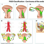 Carcinoma of the endometrium FIGO-Classification-Carcinoma-of-the-endometrium-en Carcinoma of the endometrium FIGO-Classification-Carcinoma-of-the-endometrium-en