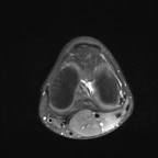 Plicae médio-patellaire pathogène DP FS Axial Plicae médio-patellaire pathogène DP FS Axial