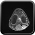 Plicae médio-patellaire pathogène DP FS Axial
