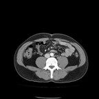 Adénocarcinome du colon transverse. TDM Abdomen Axial Temps veineux Adénocarcinome du colon transverse. TDM Abdomen Axial Temps veineux