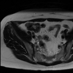 Lésion tumorale de petite taille endocarvicale, sans extension utérine paramétriale ou vaginale mise en évidence. Bilan d'extension loco-régional et à distance négatif sur cet examen. Axial T2 Grand champs Lésion tumorale de petite taille endocarvicale, sans extension utérine paramétriale ou vaginale mise en évidence. Bilan d'extension loco-régional et à distance négatif sur cet examen. Axial T2 Grand champs