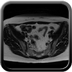 Lésion tumorale de petite taille endocarvicale, sans extension utérine paramétriale ou vaginale mise en évidence.  Bilan d'extension loco-régional et à distance négatif sur cet examen.  Axial T2 Grand champs