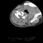Luxation rotatoire atlo-axoïdienne C1 - C2 de type I rachis Axial Luxation rotatoire atlo-axoïdienne C1 - C2 de type I rachis Axial