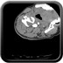 Luxation rotatoire atlo-axoïdienne C1 - C2 de type I rachis Axial