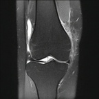 Séquelles de luxation patellaire sur dysplasie de la trochlée fémorale DP FS CORO Séquelles de luxation patellaire sur dysplasie de la trochlée fémorale DP FS CORO