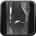 Séquelles de luxation patellaire sur dysplasie de la trochlée fémorale DP FS CORO