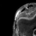 Fissure méniscale de grade III AXIAL DP FAT SAT Fissure méniscale de grade III AXIAL DP FAT SAT