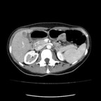 GIST gastrique avec métastases hépatiques TDM Abdomen Axial Temps veineux GIST gastrique avec métastases hépatiques TDM Abdomen Axial Temps veineux