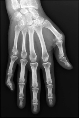 Polyarthrite rhumatoïde  Radiographie main droite