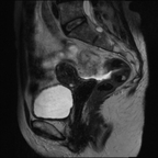Fibrothécome ovarien Sagittal T2 Fibrothécome ovarien Sagittal T2