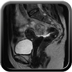 Fibrothécome ovarien Sagittal T2