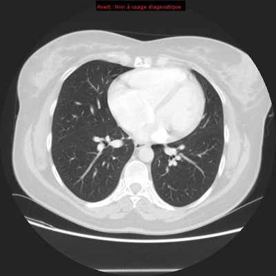 Veine cave supérieure gauche et retour veineux pulmonaire anormal partiel  TDM Thorax Axial Fenêtre Air