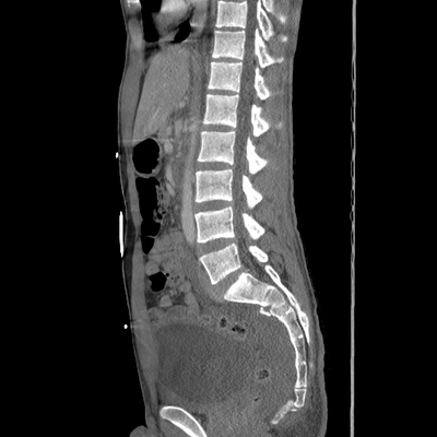 Thoracic Injuries, Subcapsular hemorrhage of liver, Pelvic injury Abdomen, Sagittal plane
