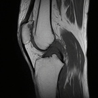 Kyste mucoïde du genou IRM du genou Sagittal T1 TSE Kyste mucoïde du genou IRM du genou Sagittal T1 TSE