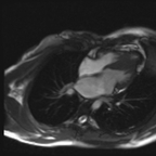 Cardiomyopathie hypertrophique primitive Cine-IRM 4 cavités Cardiomyopathie hypertrophique primitive Cine-IRM 4 cavités