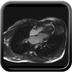 Cardiomyopathie hypertrophique primitive Cine-IRM 4 cavités