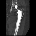 Descellement cotyloidien granulomateux avec débricolage de l'implant cotyloidien TDM coronal fenetrage os Descellement cotyloidien granulomateux avec débricolage de l'implant cotyloidien TDM coronal fenetrage os