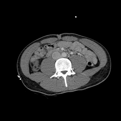 Craniocerebral trauma, Pulmonary edema, Renal injury Abdomen CT, Portal venous phase, Axial plane