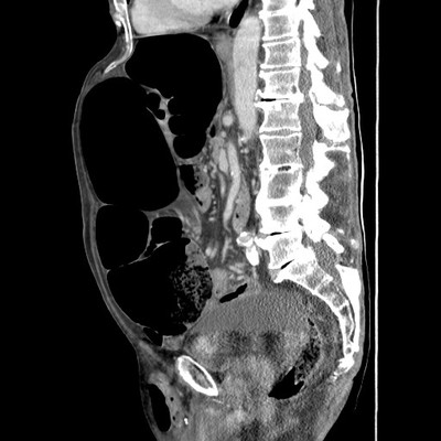 Sigmoid volvulus Sagittal