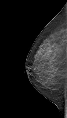 Carcinome canalaire in situ supéro-médian droit RML Tomosynthèse