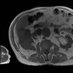 Adénocarcinome rénal droit avec envahissement de la veine rénale et de la VCI T1 axial Adénocarcinome rénal droit avec envahissement de la veine rénale et de la VCI T1 axial