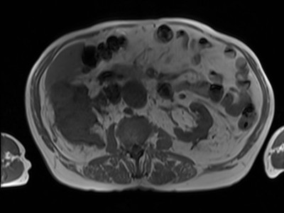 Adénocarcinome rénal droit avec envahissement de la veine rénale et de la VCI T1 axial