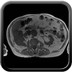 Adénocarcinome rénal droit avec envahissement de la veine rénale et de la VCI T1 axial