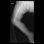 Fracture tibiale non déplacée RX J0 Fracture tibiale non déplacée RX J0