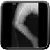 Fracture tibiale non déplacée RX J0