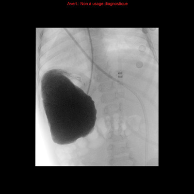 Volvulus gastrique associé à une rate oscillante TOGD