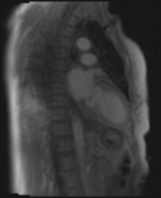 Syndrome de Tako-Tsubo - Myocardite adrénergique Perfusion de premier passage - VLA