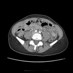 Peritonite sur salpingite. TDM Abdomen Pelvis Axial Temps veineux Peritonite sur salpingite. TDM Abdomen Pelvis Axial Temps veineux