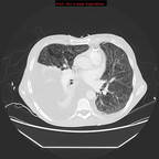Lymphangioléiomyomatose, chylothorax et angiomyolipomes rénaux sur sclérose tubéreuse de Bourneville TDM Thorax Axial Fenêtre Air Lymphangioléiomyomatose, chylothorax et angiomyolipomes rénaux sur sclérose tubéreuse de Bourneville TDM Thorax Axial Fenêtre Air