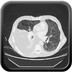 Lymphangioléiomyomatose, chylothorax et angiomyolipomes rénaux sur sclérose tubéreuse de Bourneville  TDM Thorax Axial Fenêtre Air