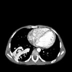 Malformation artério-veineuse lobaire inférieure droite complexe dans le cadre d'une maladie de Rendu-Osler TDM médiastin Malformation artério-veineuse lobaire inférieure droite complexe dans le cadre d'une maladie de Rendu-Osler TDM médiastin