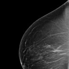 Discordance en imagerie avec macrobiopsie sans élément tumoral: décision de surveillance RML Discordance en imagerie avec macrobiopsie sans élément tumoral: décision de surveillance RML