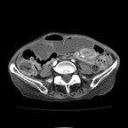 Hernie interne transmésentérique TDM Abdomen Axial Temps veineux Hernie interne transmésentérique TDM Abdomen Axial Temps veineux