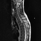 Fracture tassement par mécanisme de compression distraction de T2 avec atteinte disco-ligamentaire sagittal T2 Fracture tassement par mécanisme de compression distraction de T2 avec atteinte disco-ligamentaire sagittal T2