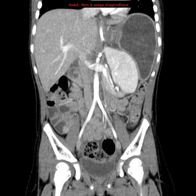 Volvulus gastrique associé à une rate oscillante TDM abdomino-pelvienne (coronal)