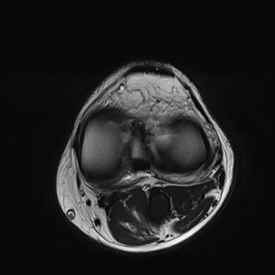 Anévrysme poplité thrombosé T2 Axial