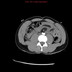 Hématome du foie avec saignement actif embolisé par coils  TDM Abdomen Axial Temps artériel