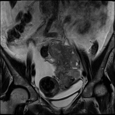 Cystadénocarcinome ovarien séro-papillaire moyennement différencié Stade IIIb Coronal T2
