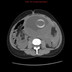 Rupture splénique spontanée chez une patiente enceinte  TDM Abdomen Axial Sans injection