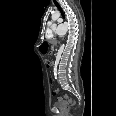 traumatisme ouvert abdominal, saignement actif pariétal TAP artériel sag
