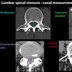 Lumbar spinal stenosis Lumbar-spinal-stenosis-canal-diameter-en