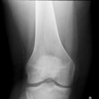 Dysplasie trochléenne avec stigmates de luxation patellaire Genou droit Face Dysplasie trochléenne avec stigmates de luxation patellaire Genou droit Face
