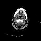 Fracture instable bi-isthmique de C2 avec hématome épidural Crane et Rachis cervical Fracture instable bi-isthmique de C2 avec hématome épidural Crane et Rachis cervical